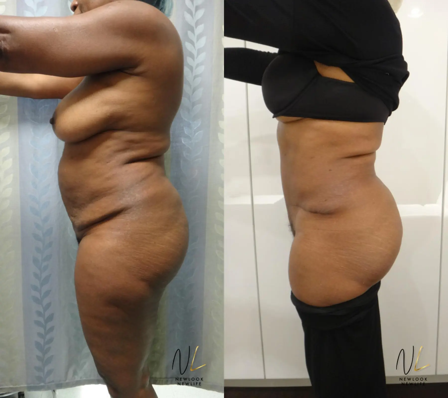 Tummy Tuck: Patient 6 - Before and After 2