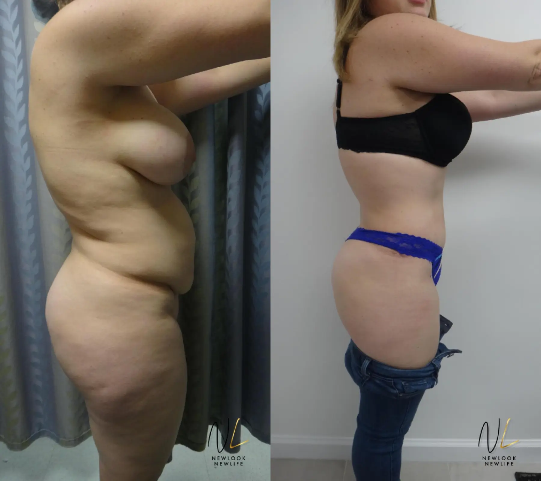 Tummy Tuck: Patient 26 - Before and After 3