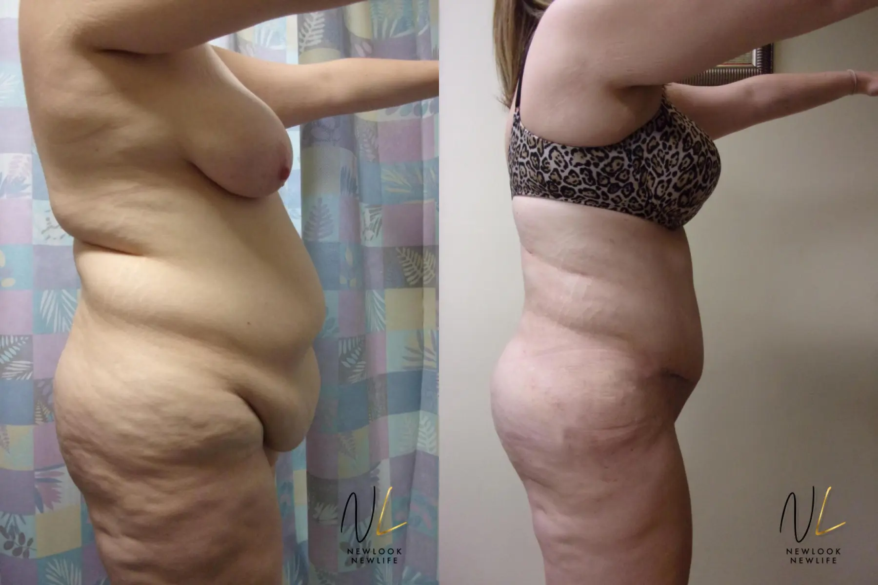 Tummy Tuck: Patient 7 - Before and After 3