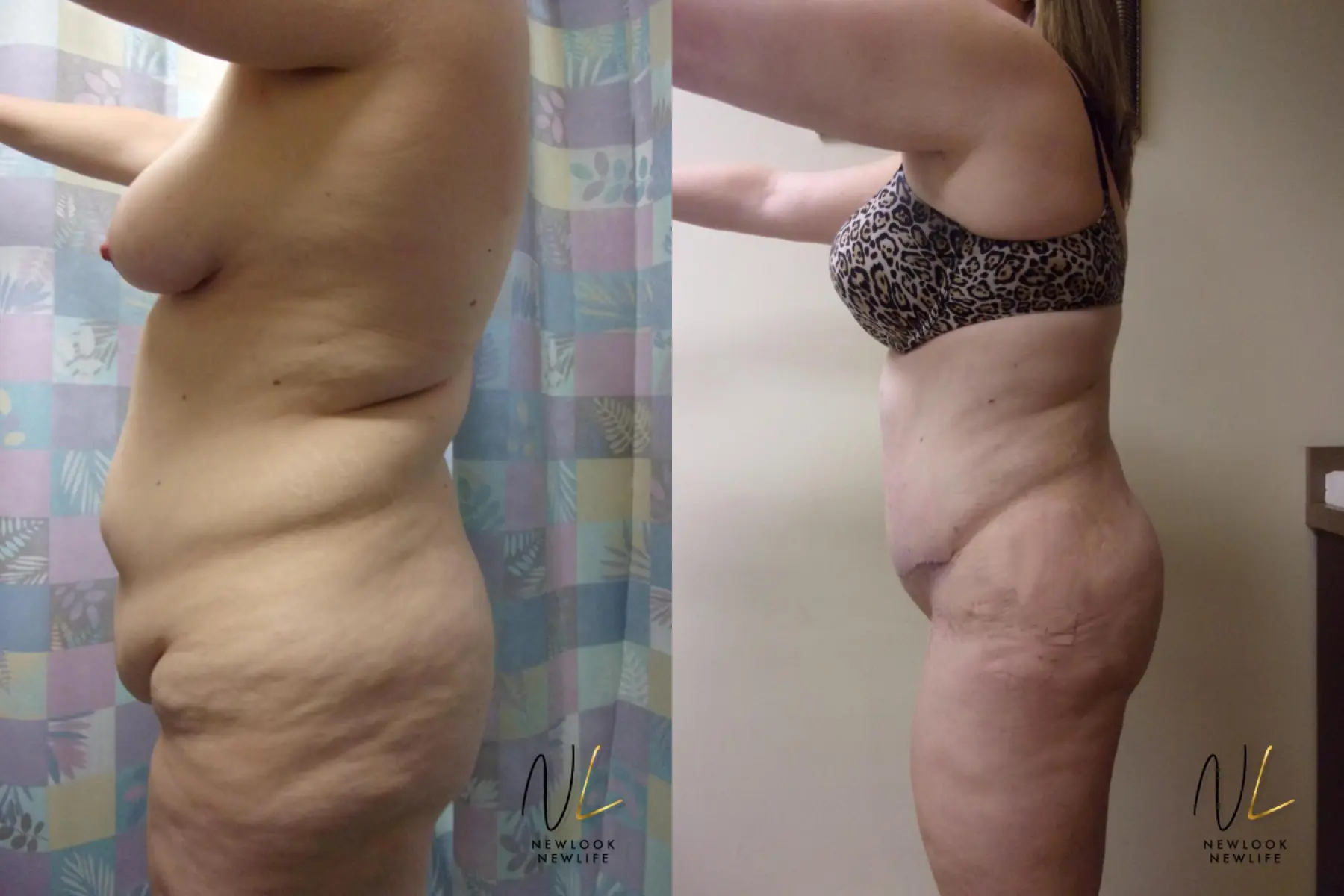 Tummy Tuck: Patient 7 - Before and After 2