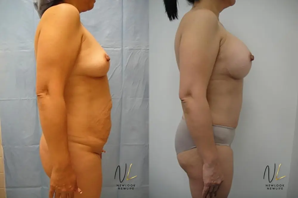 Tummy Tuck: Patient 13 - Before and After 3