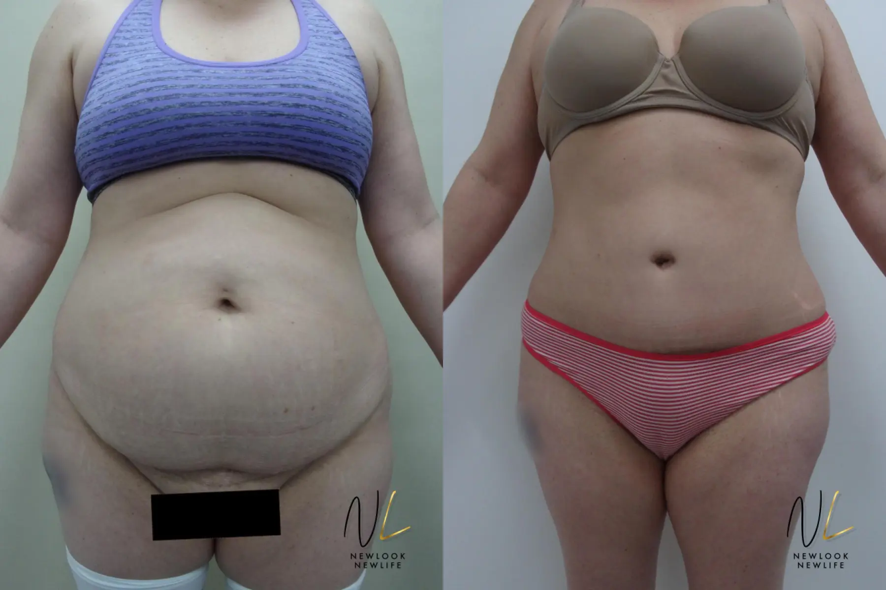 Tummy Tuck: Patient 24 - Before and After 1