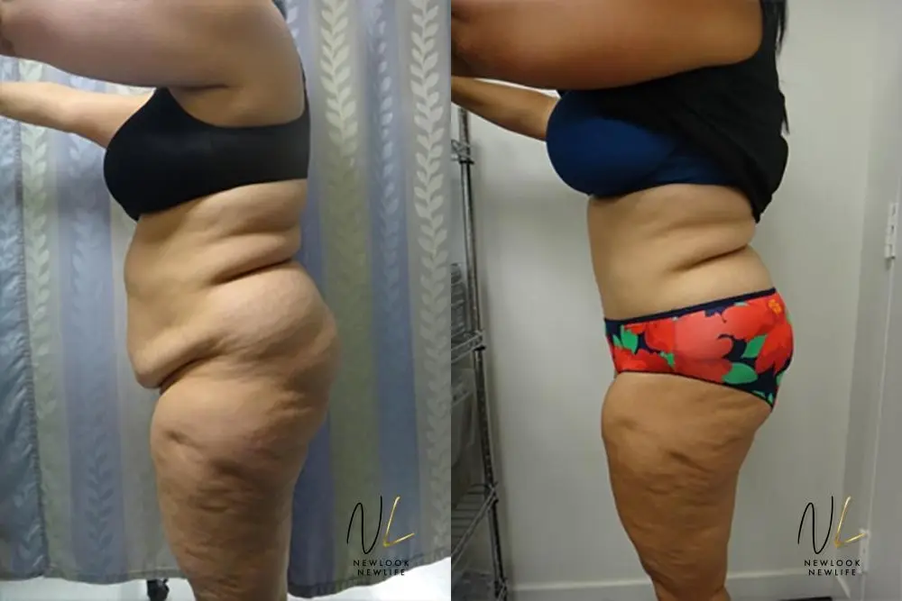 Tummy Tuck: Patient 18 - Before and After 2