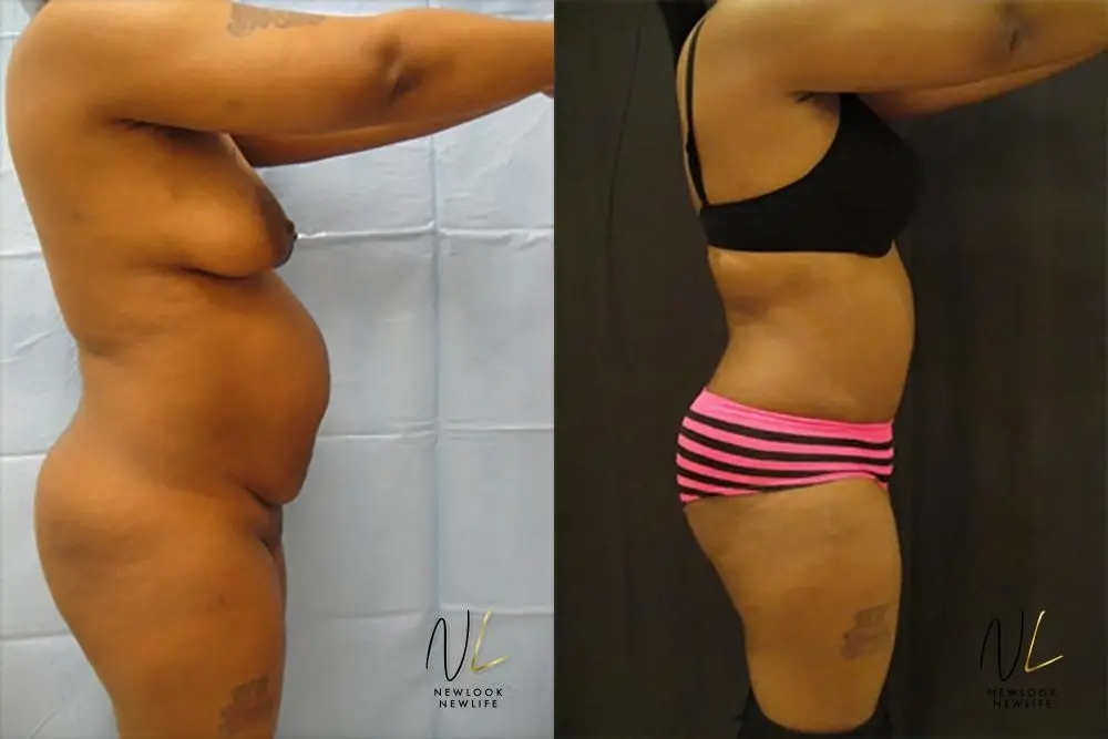 Tummy Tuck: Patient 14 - Before and After 3