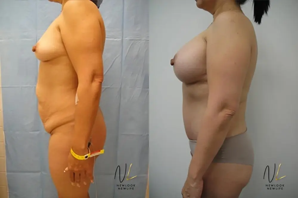 Tummy Tuck: Patient 23 - Before and After 2