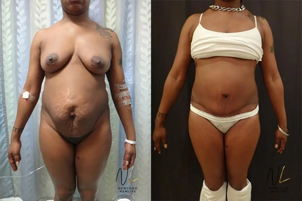 Tummy Tuck: Patient 17 - Before and After 1