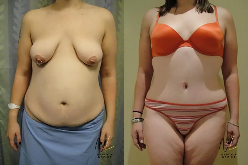 Tummy Tuck: Patient 12 - Before and After 1