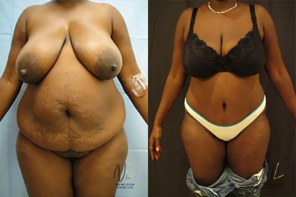 Tummy Tuck: Patient 15 - Before and After 1