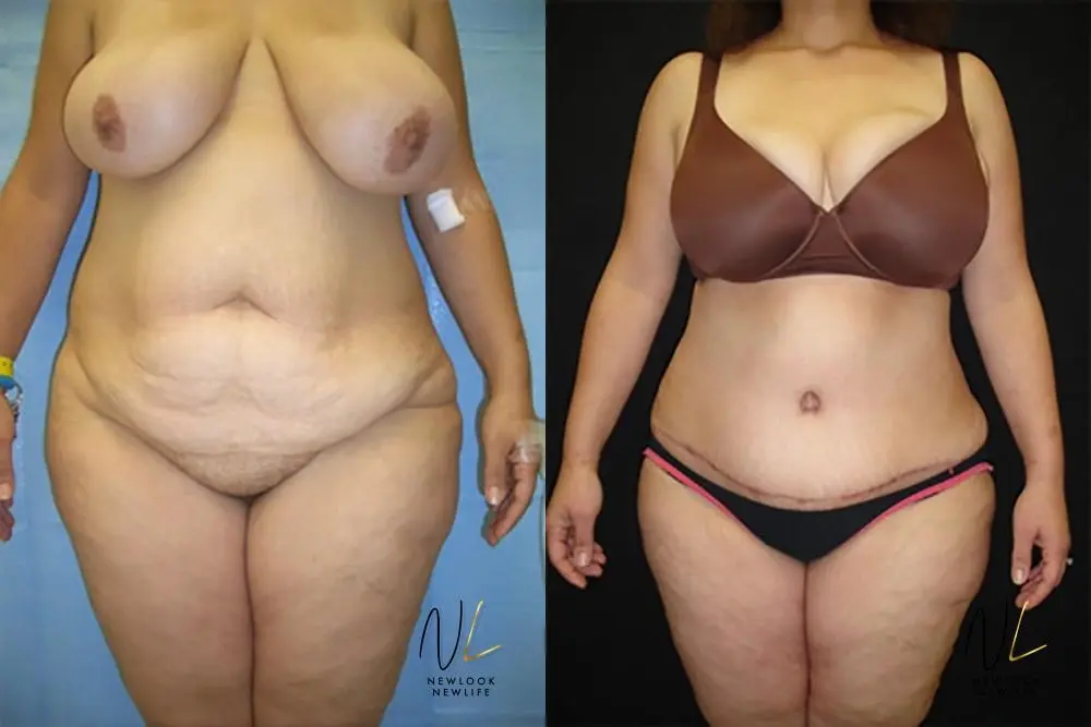 Tummy Tuck: Patient 22 - Before and After 1