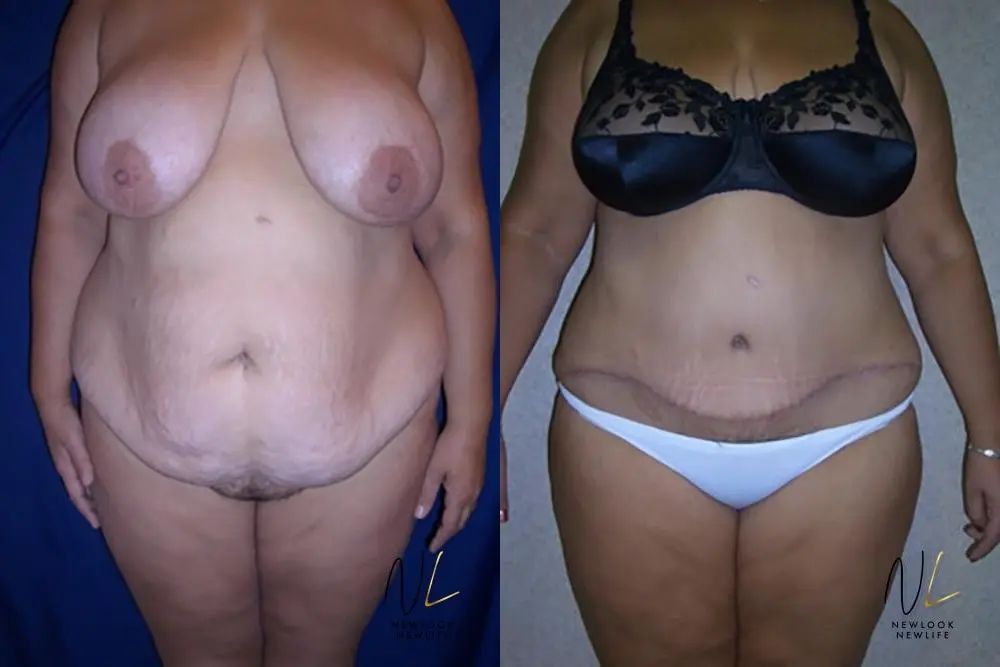 Tummy Tuck: Patient 11 - Before and After 1