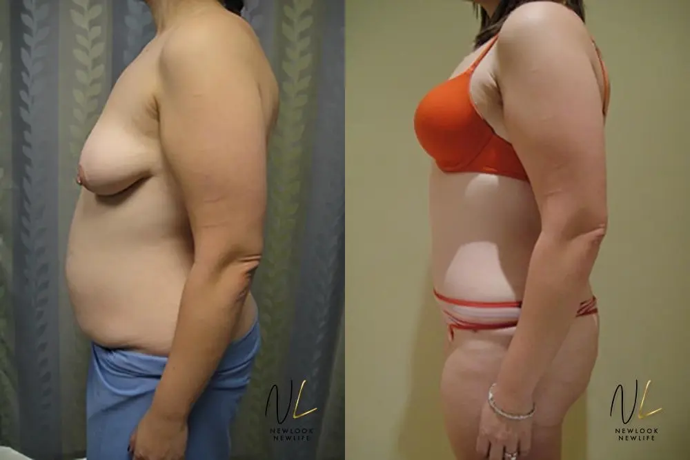 Tummy Tuck: Patient 12 - Before and After 2