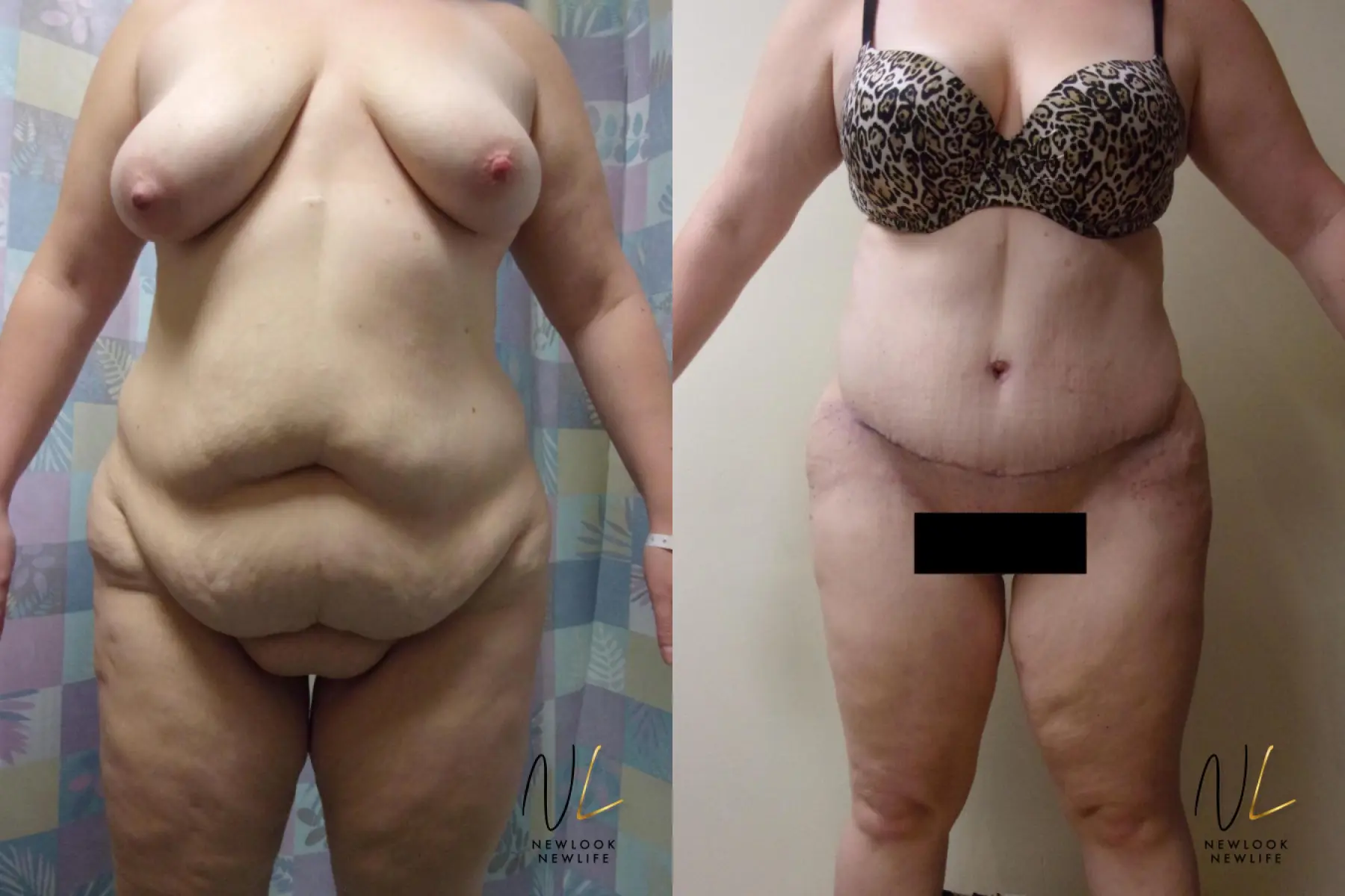 Tummy Tuck: Patient 7 - Before and After  