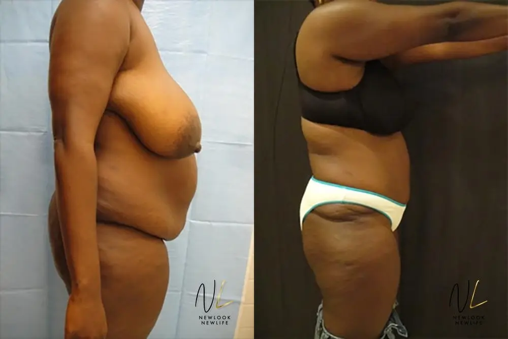 Tummy Tuck: Patient 15 - Before and After 3