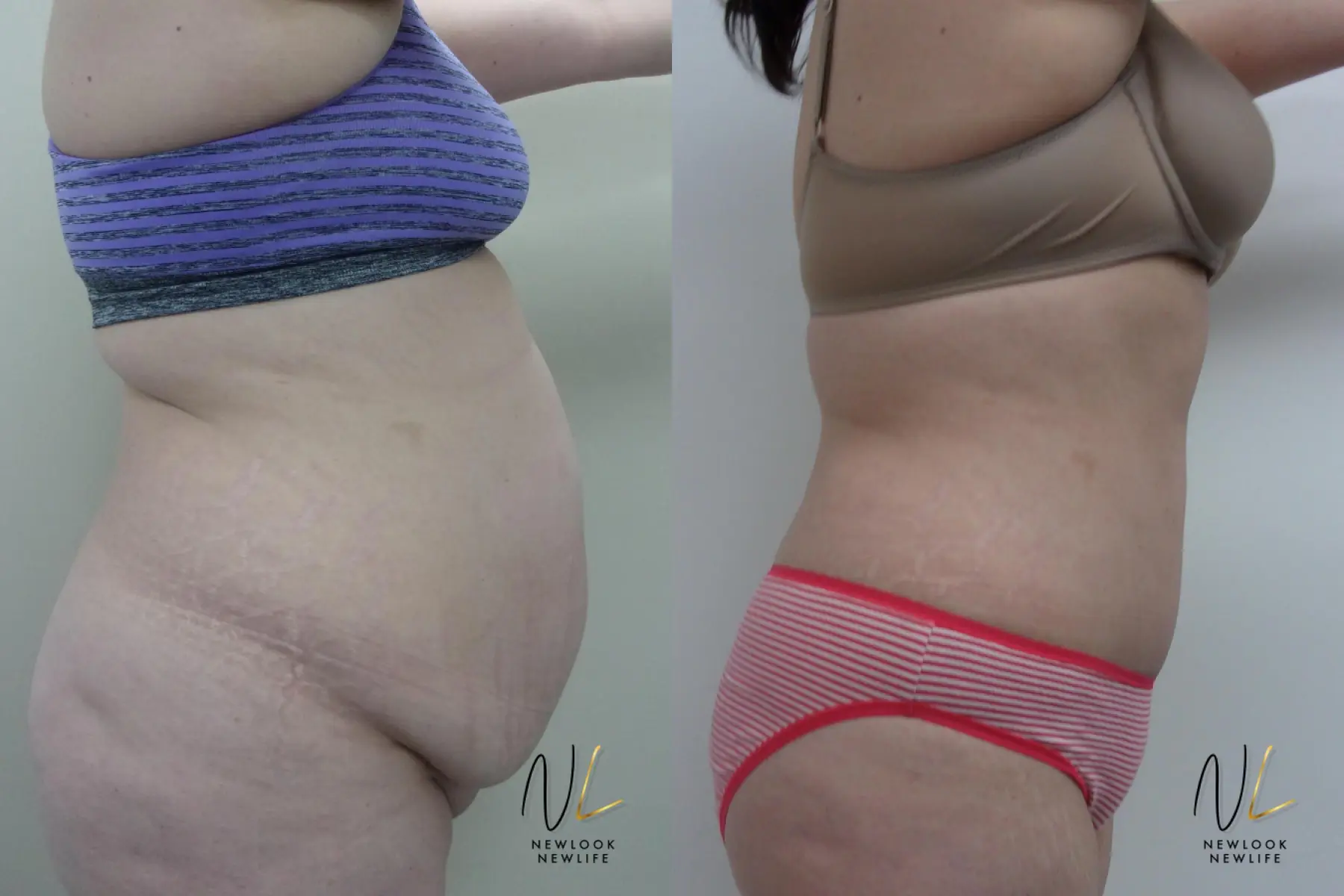 Tummy Tuck: Patient 24 - Before and After 2