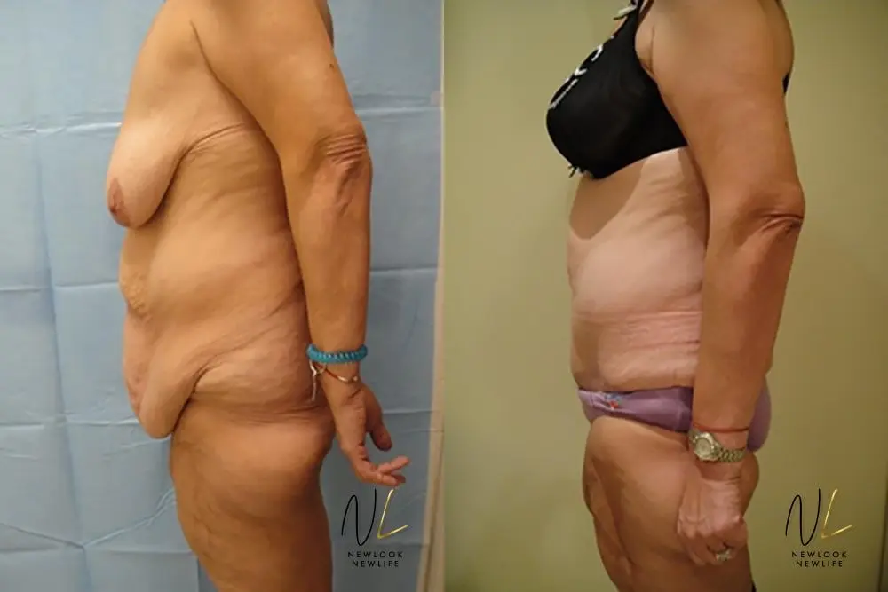 Tummy Tuck: Patient 10 - Before and After 2