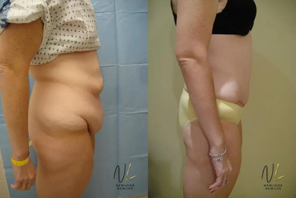 Tummy Tuck: Patient 8 - Before and After 3