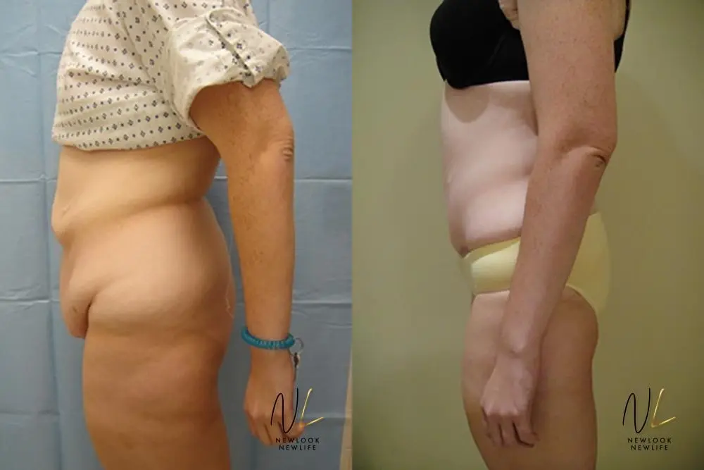 Tummy Tuck: Patient 8 - Before and After 2