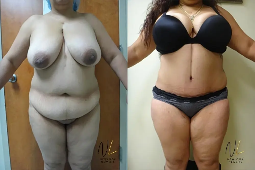 Tummy Tuck: Patient 5 - Before and After  