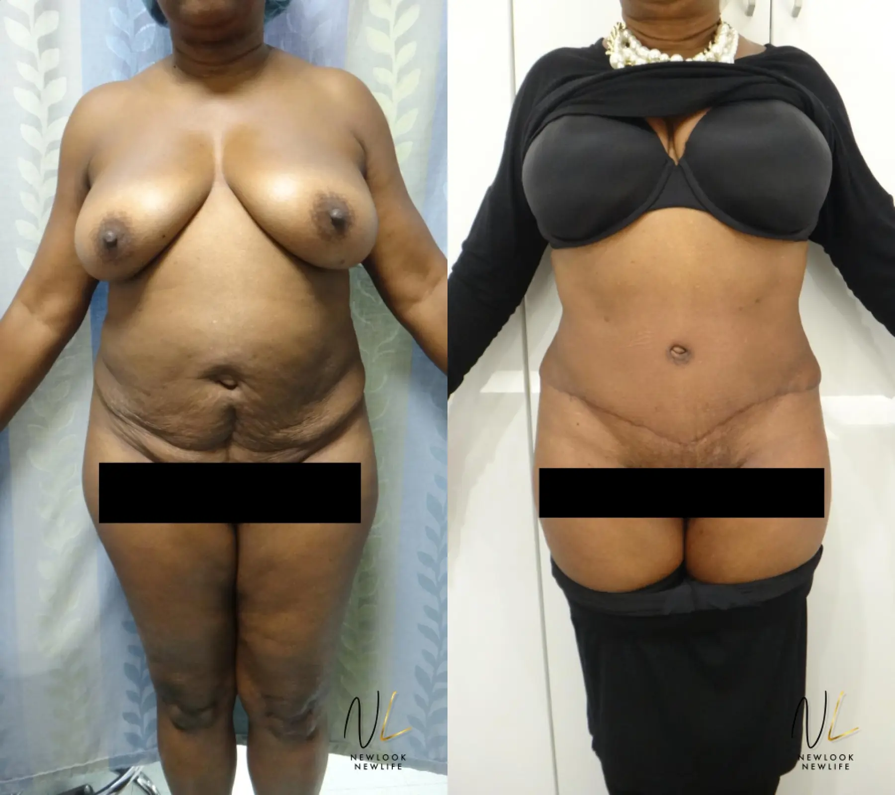 Tummy Tuck: Patient 6 - Before and After 1