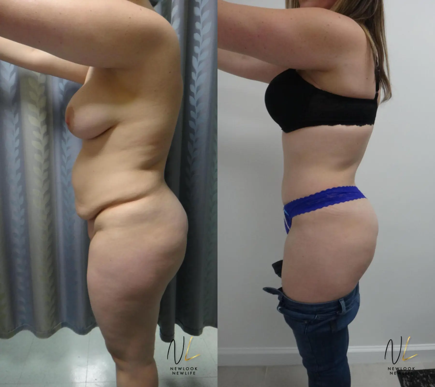 Tummy Tuck: Patient 26 - Before and After 2