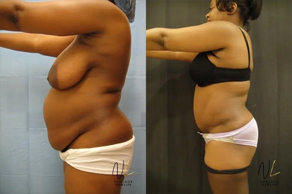 Tummy Tuck: Patient 21 - Before and After 2