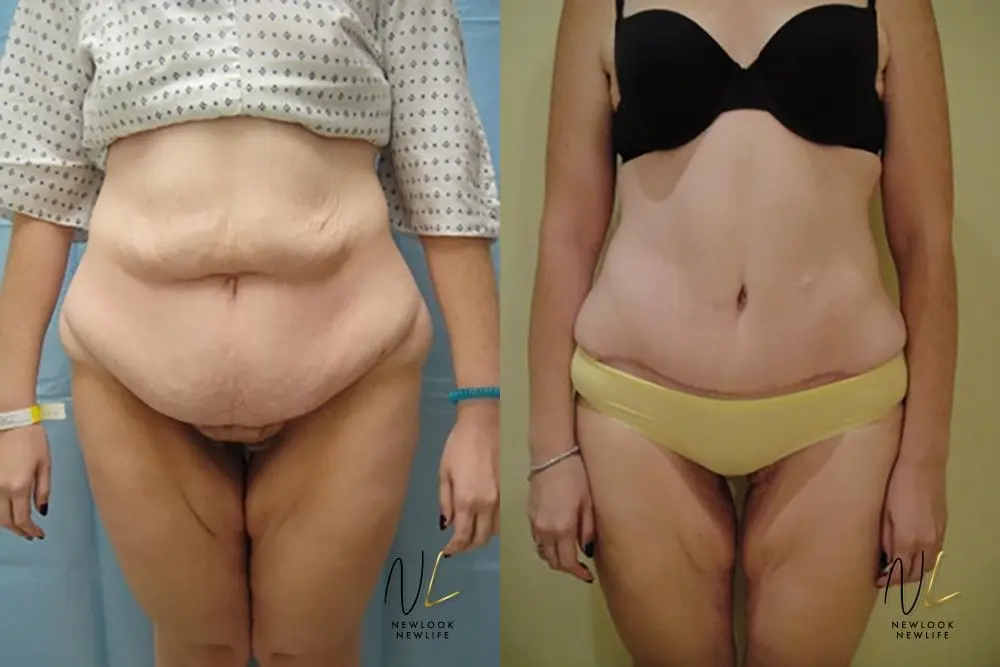 Tummy Tuck: Patient 8 - Before and After 1