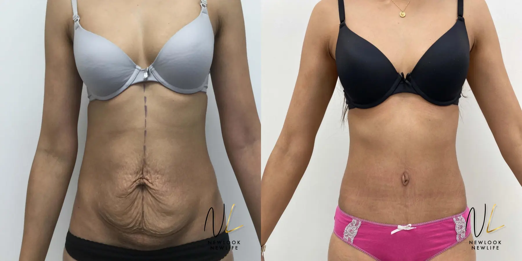 Tummy Tuck: Patient 9 - Before and After  