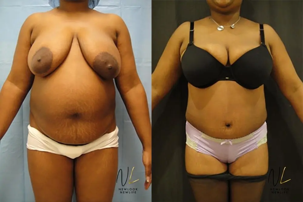 Tummy Tuck: Patient 16 - Before and After 1