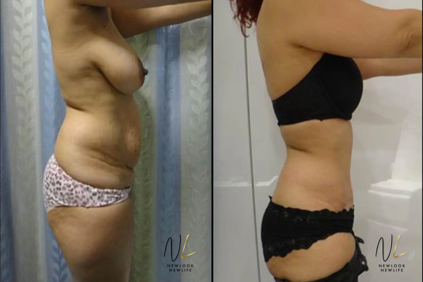 Tummy Tuck: Patient 27 - Before and After 2