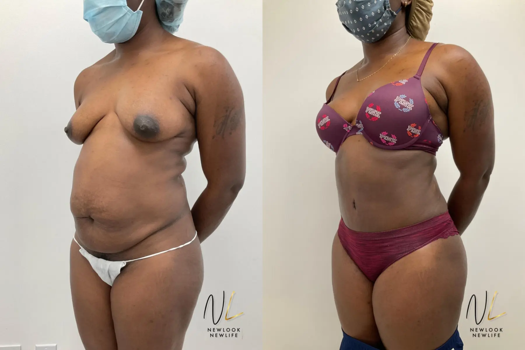 Tummy Tuck: Patient 2 - Before and After 2