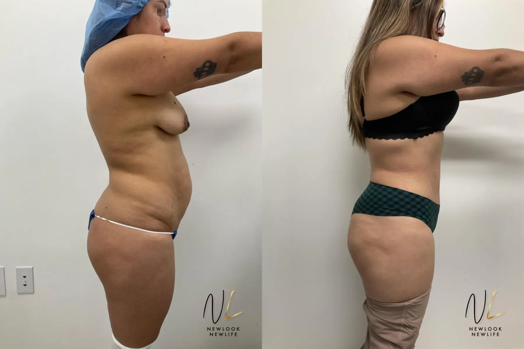 Tummy Tuck: Patient 4 - Before and After 3