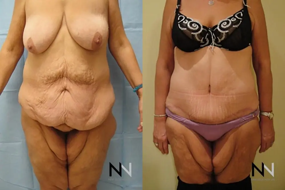 Tummy Tuck: Patient 10 - Before and After  