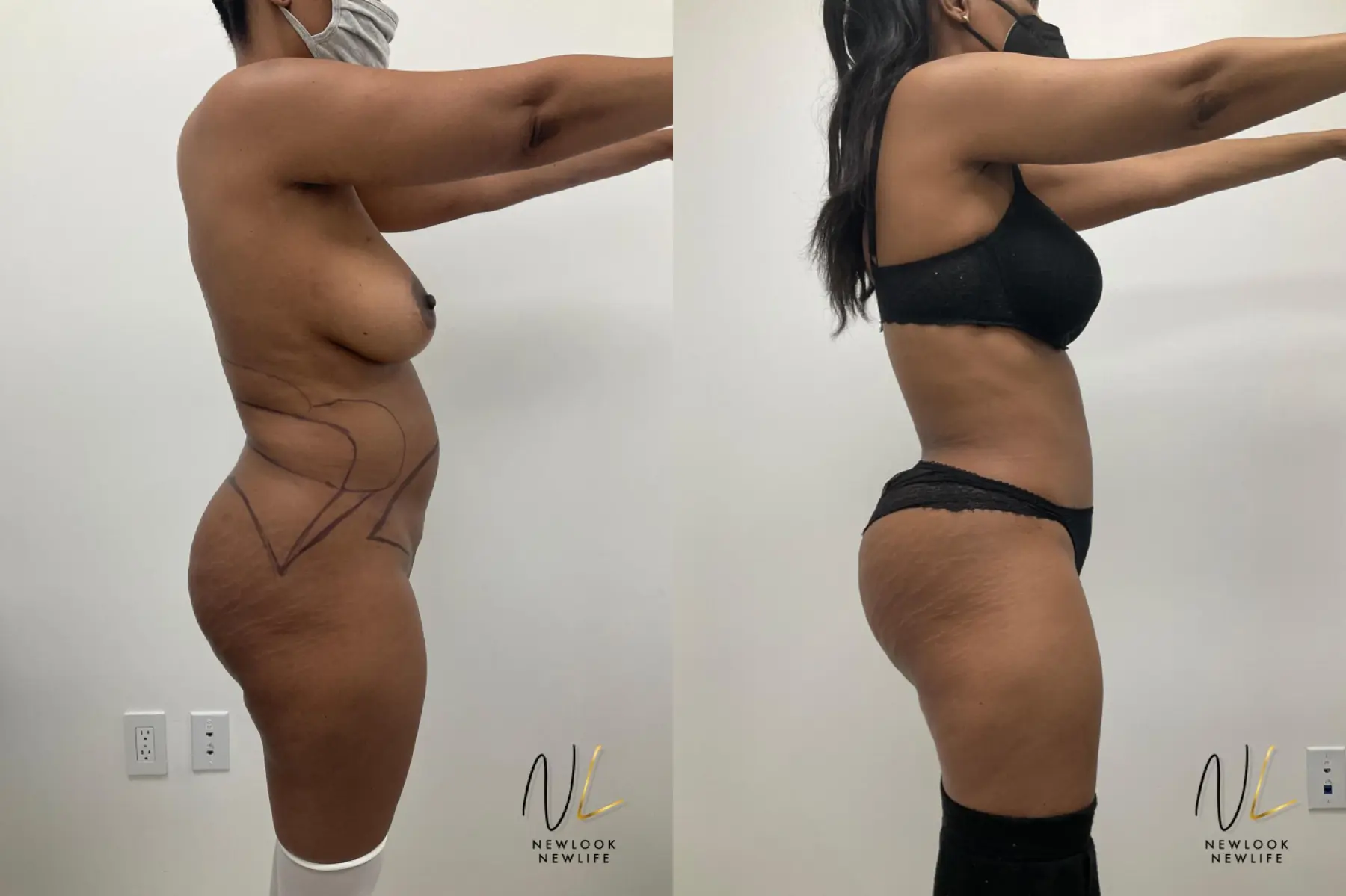 Tummy Tuck: Patient 1 - Before and After 4