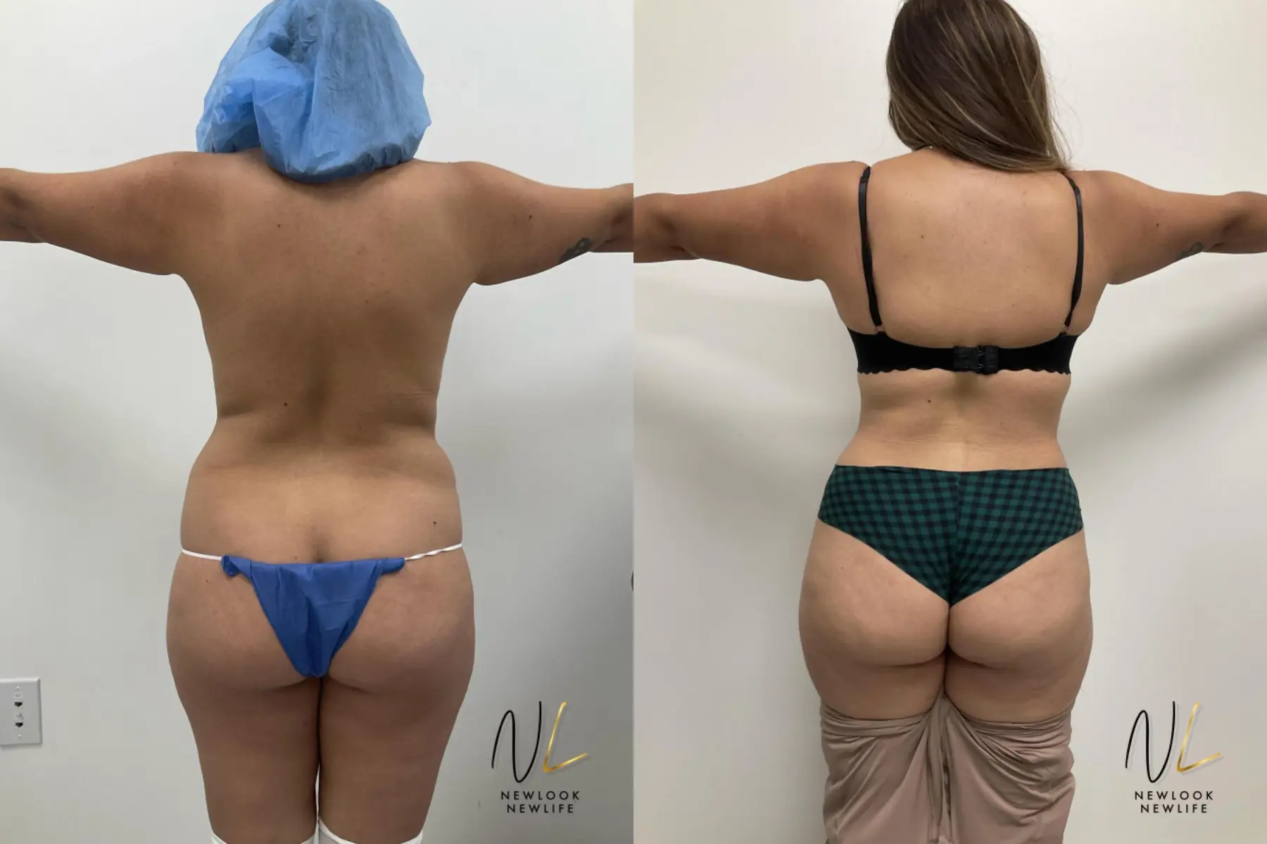 Tummy Tuck: Patient 4 - Before and After 2