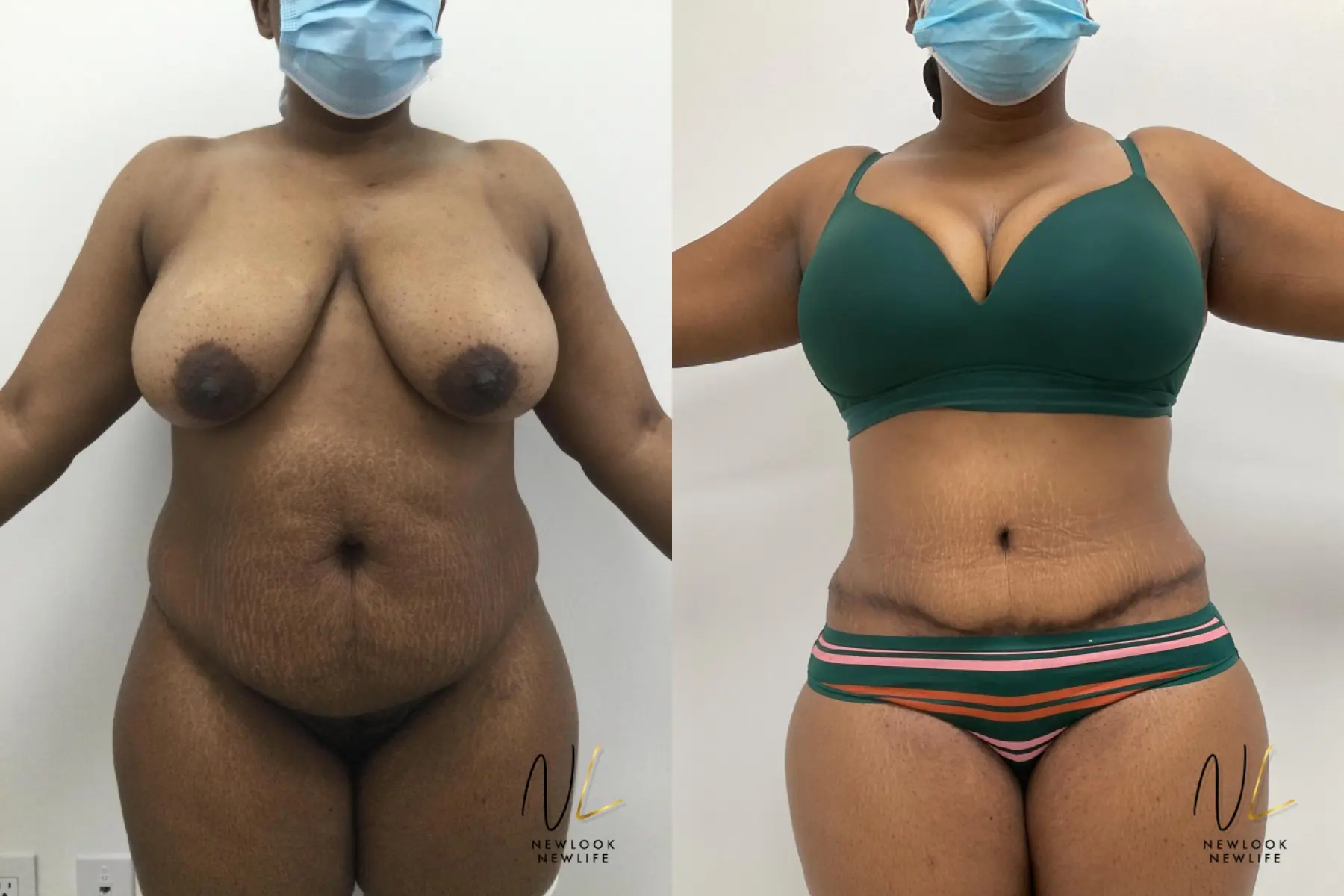 Tummy Tuck: Patient 3 - Before and After 1