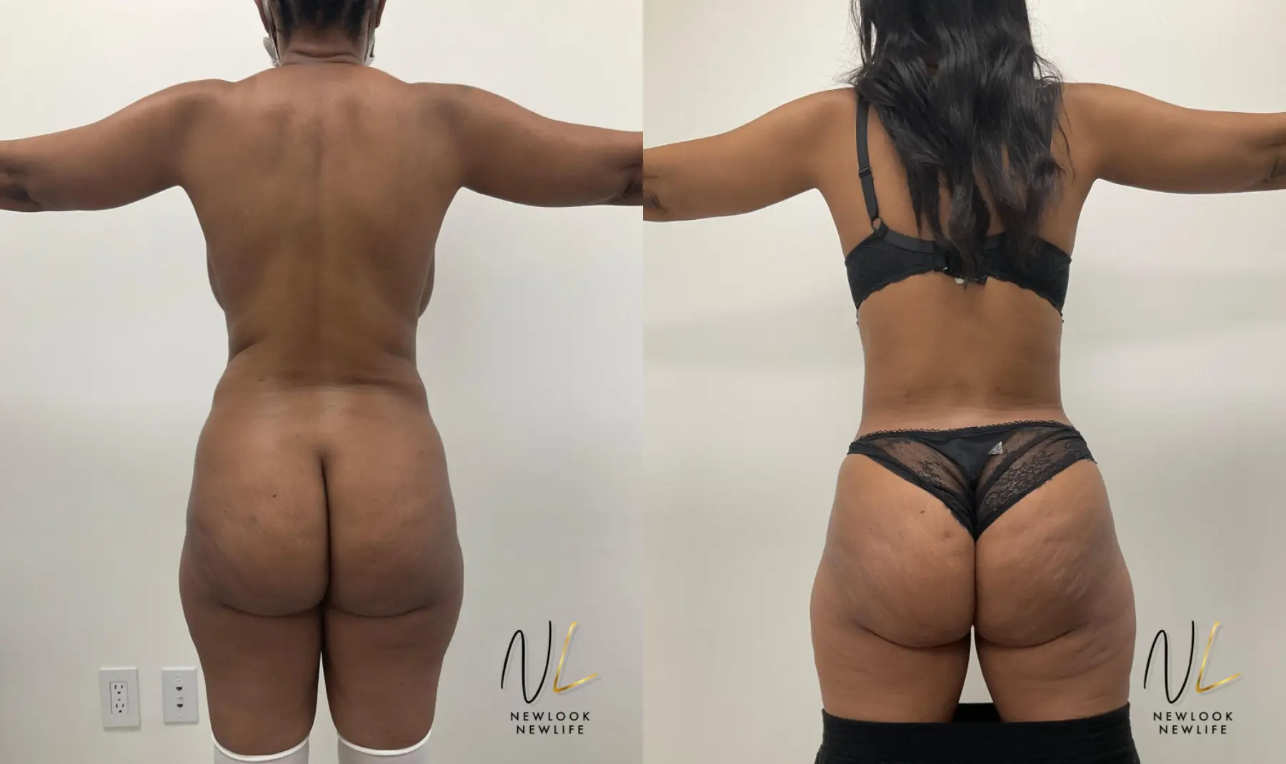 Tummy Tuck: Patient 1 - Before and After 2