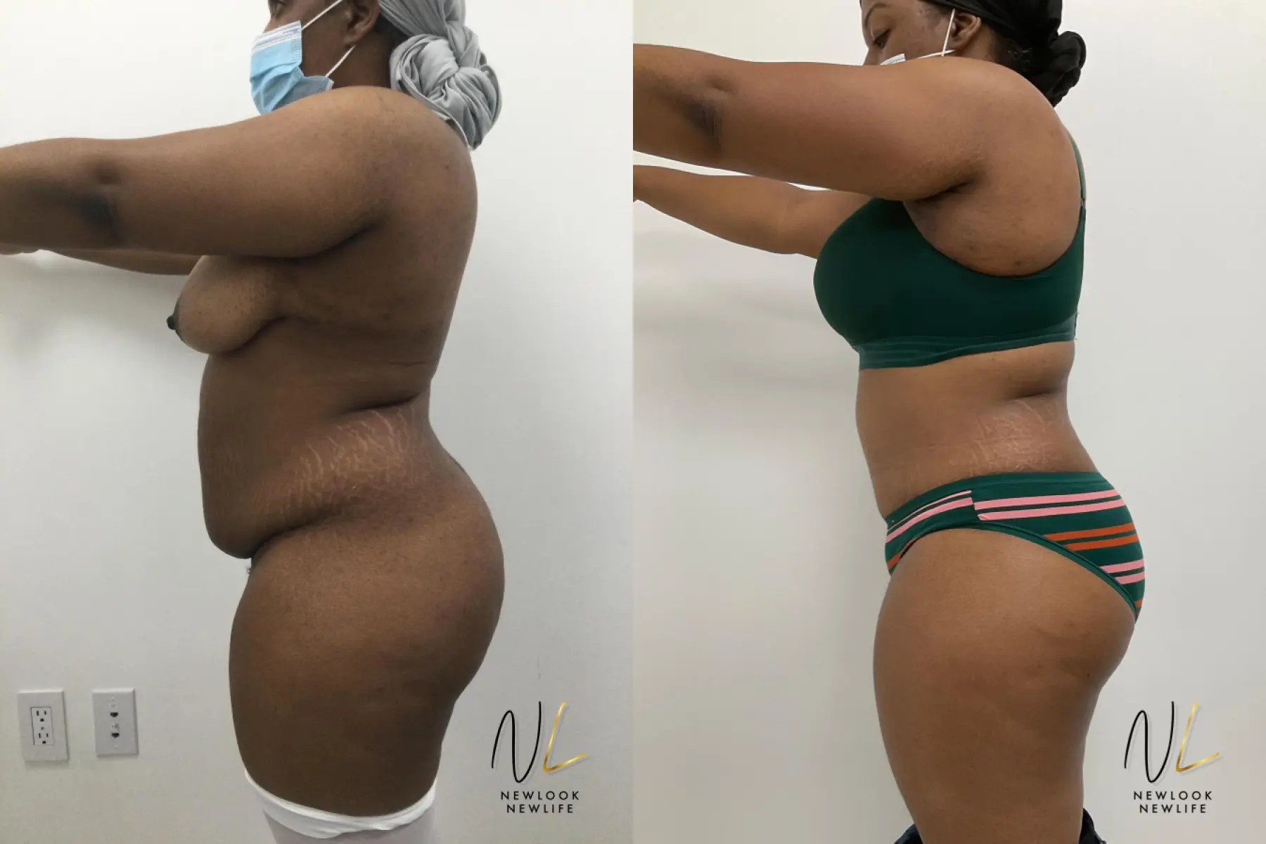 Tummy Tuck: Patient 3 - Before and After 2