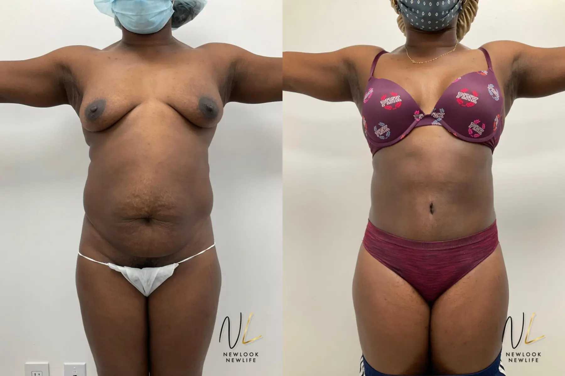 Tummy Tuck: Patient 2 - Before and After 1