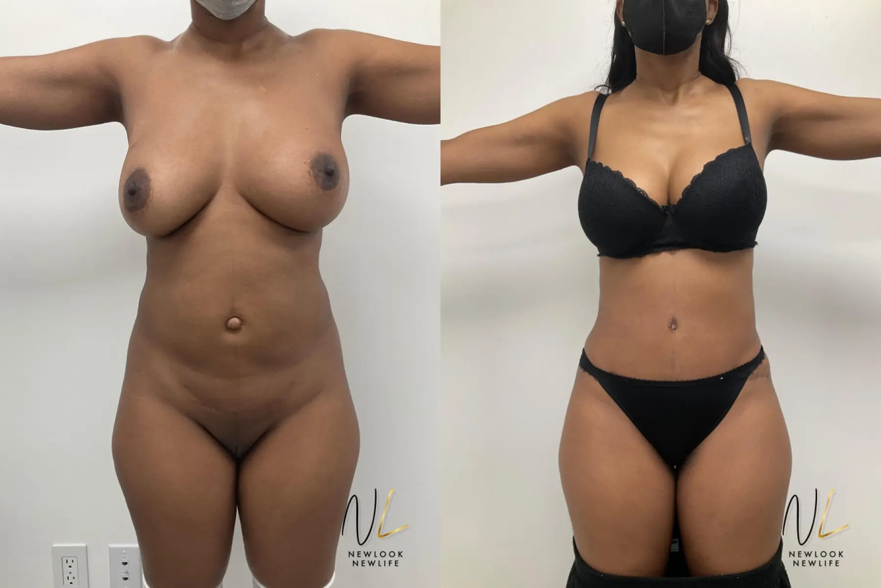 Tummy Tuck: Patient 1 - Before and After 1