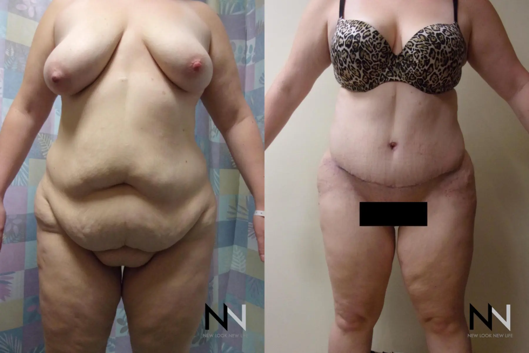 Tummy Tuck: Patient 7 - Before and After  