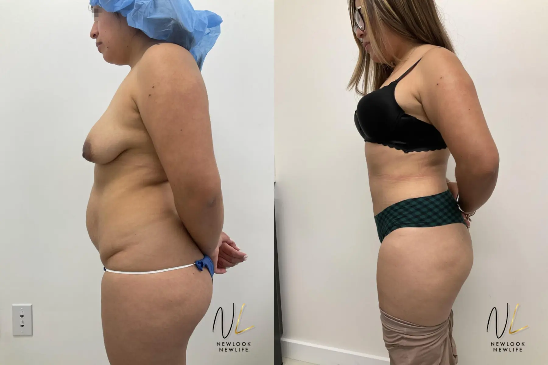 Tummy Tuck: Patient 4 - Before and After 4