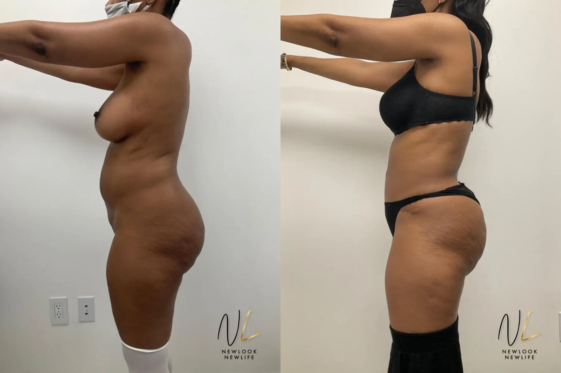 Tummy Tuck: Patient 1 - Before and After 3