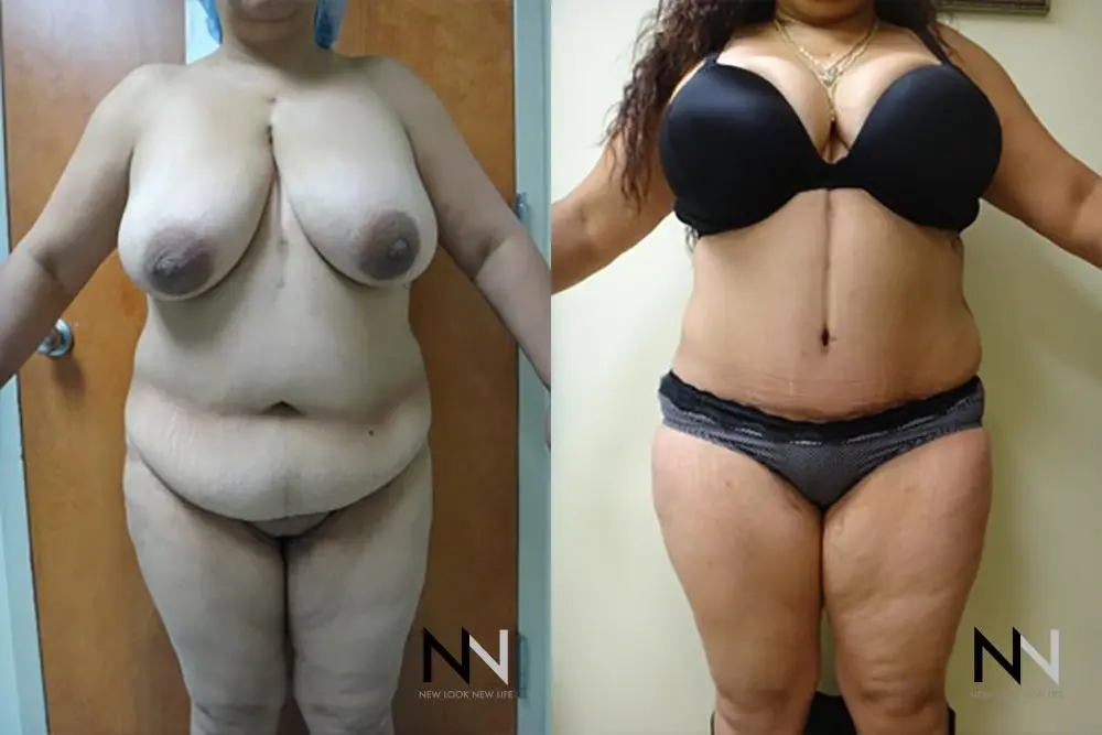 Tummy Tuck: Patient 5 - Before and After  