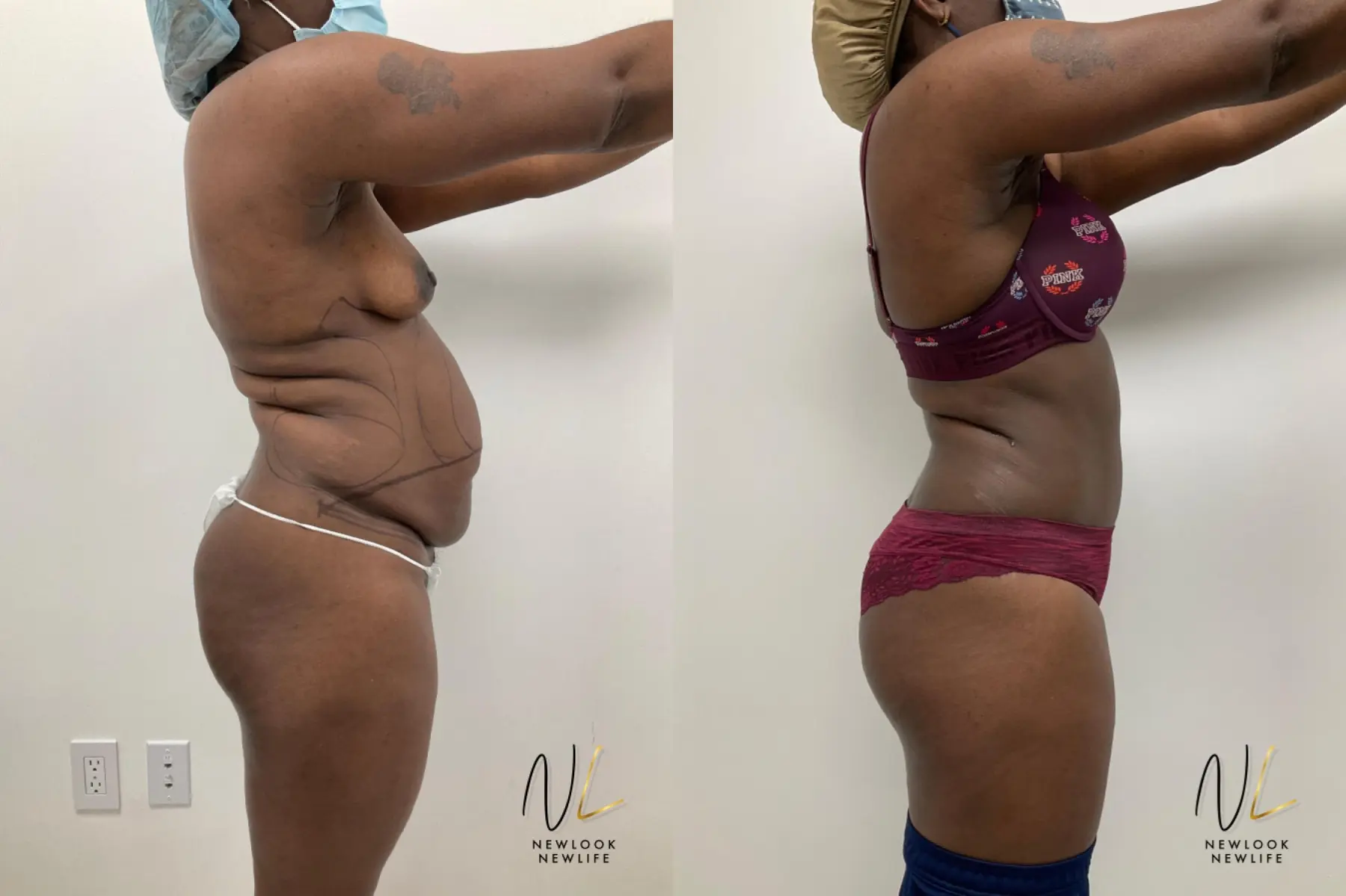 Tummy Tuck: Patient 2 - Before and After 3