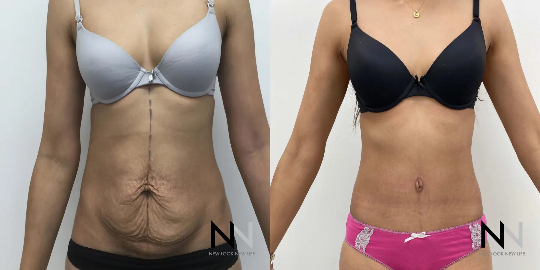 Tummy Tuck: Patient 9 - Before and After  