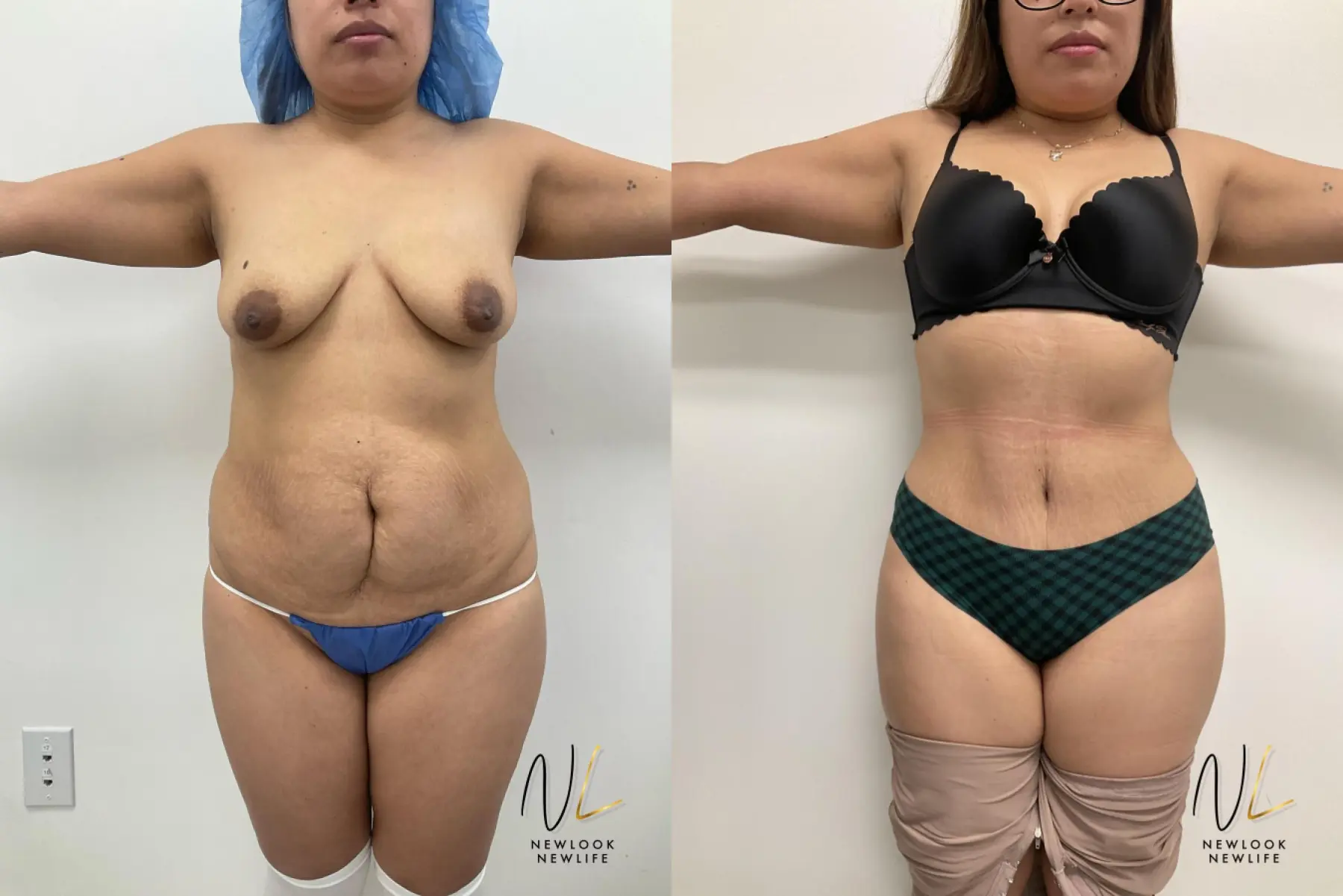 Tummy Tuck: Patient 4 - Before and After  