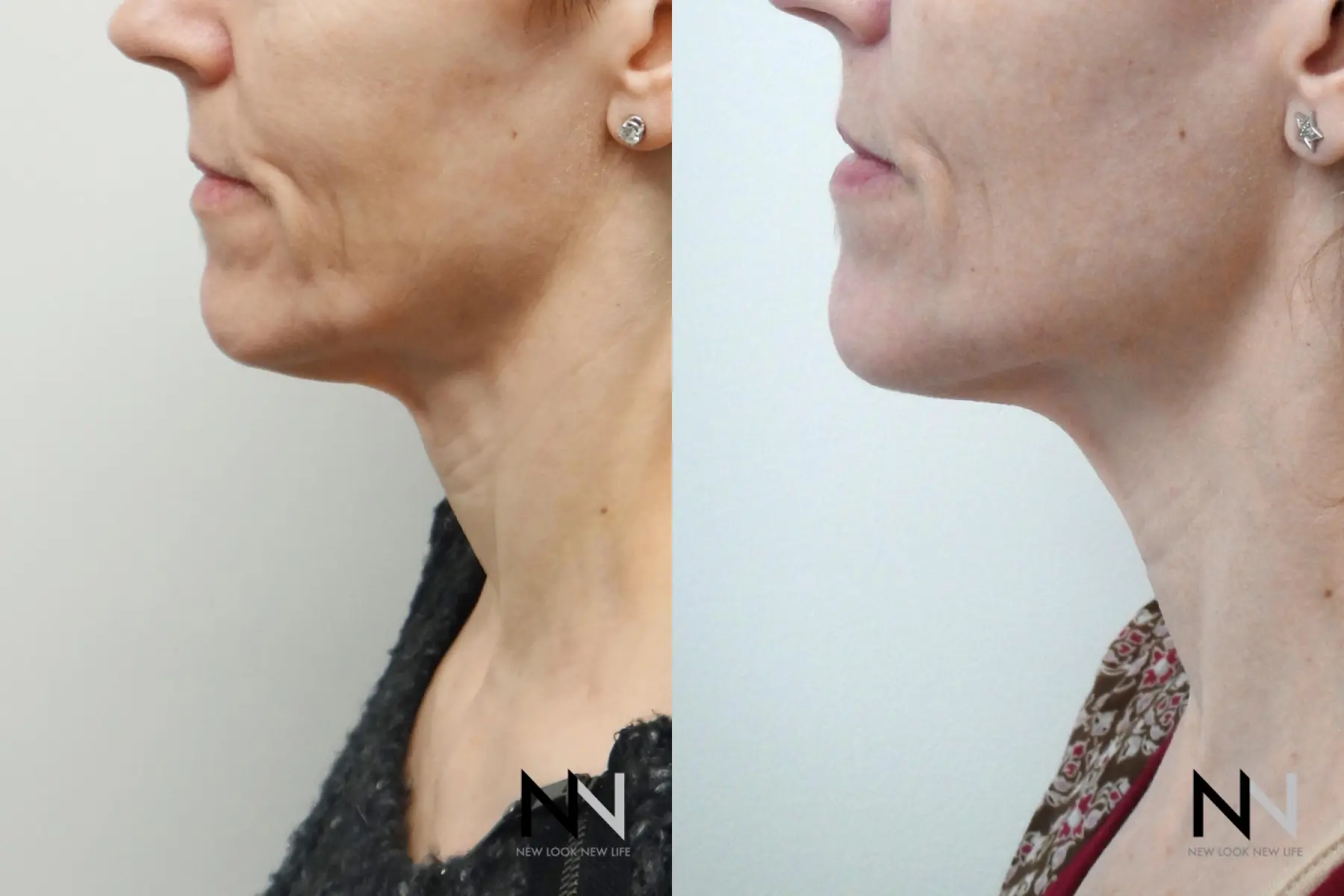 Ultherapy: Patient 1 - Before and After  