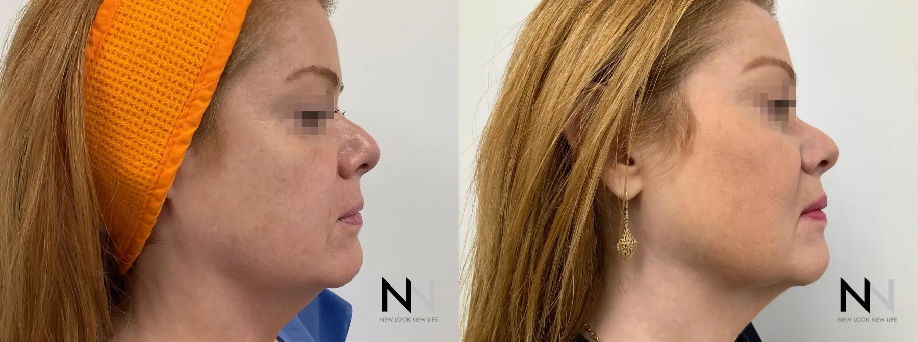 Ultherapy: Patient 4 - Before and After  