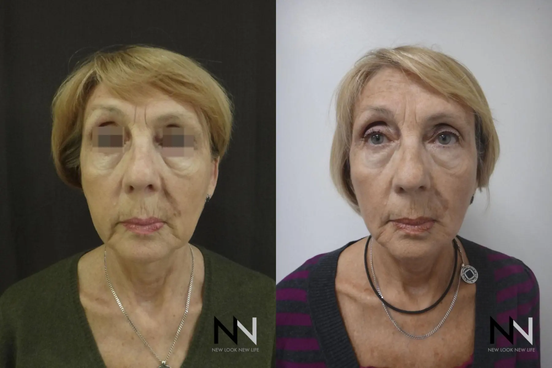 Ultherapy: Patient 2 - Before and After  