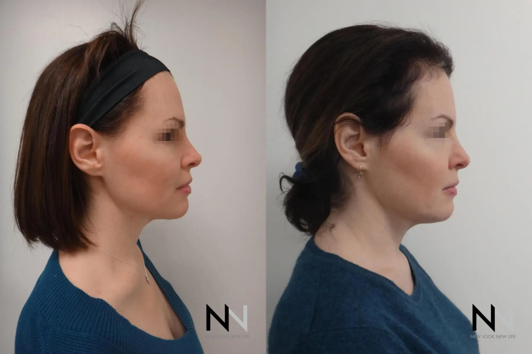 Ultherapy: Patient 3 - Before and After  